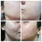 ANTI ACNE & GLOWING SERUM VITAMIN C + E