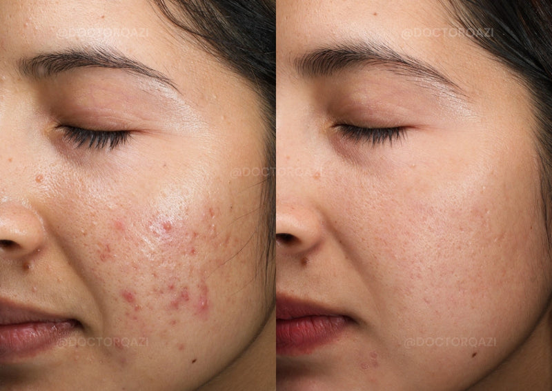 ANTI ACNE & GLOWING SERUM VITAMIN C + E