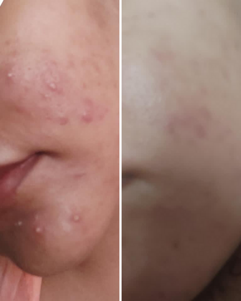 ANTI ACNE & GLOWING SERUM VITAMIN C + E